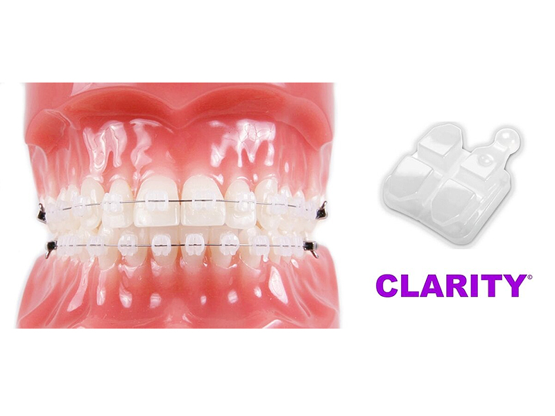 Брекеты Clarity 3M Unitek: когда эстетика встречается с эффективностью