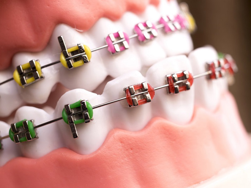 Ортодонтические лигатуры: металлические, эластомерные, самолигирующиеся системы