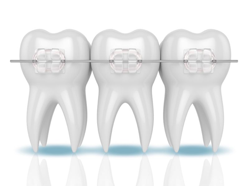 Преимущество брекет-систем Ormco Damon перед другими брекет-системами