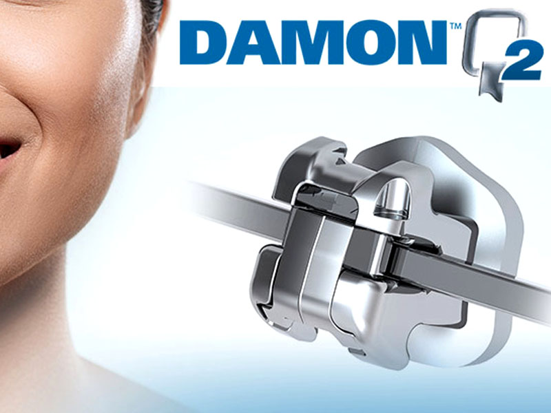 Типодонт Damon Q2 Ormco: что это такое и зачем он нужен стоматологу