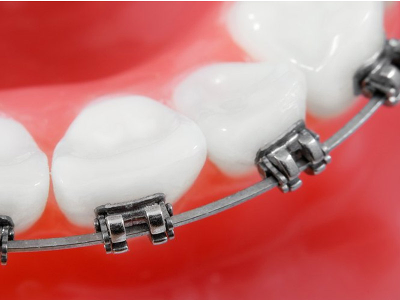 Как выбрать ортодонтические дуги: виды, параметры, совместимость