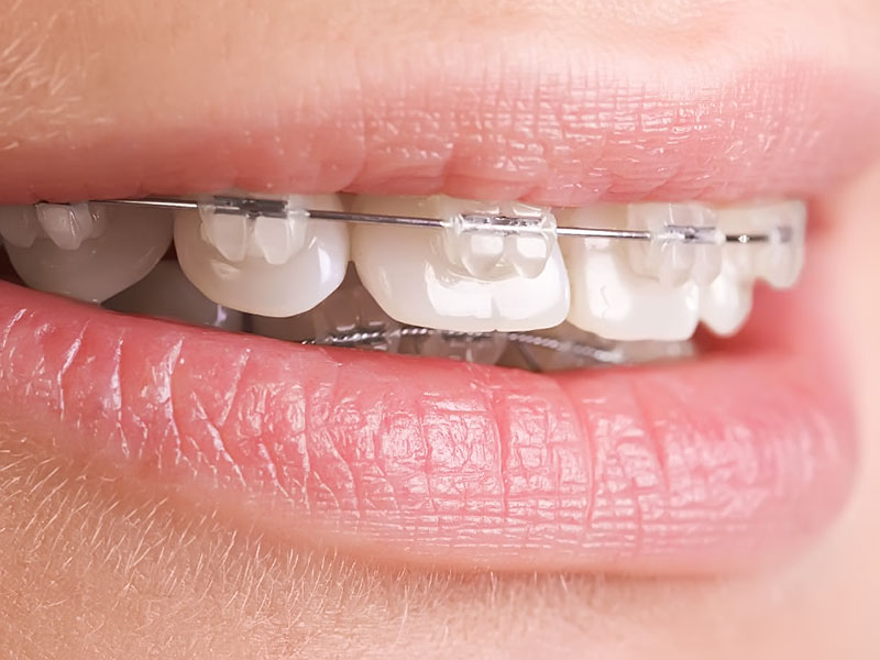 Сравнение разных типов брекетов Ormco Damon: Damon Q,  Damon Q2, Damon Q с крючком, Damon Clear, Damon Clear 2, Damon 3 MX.