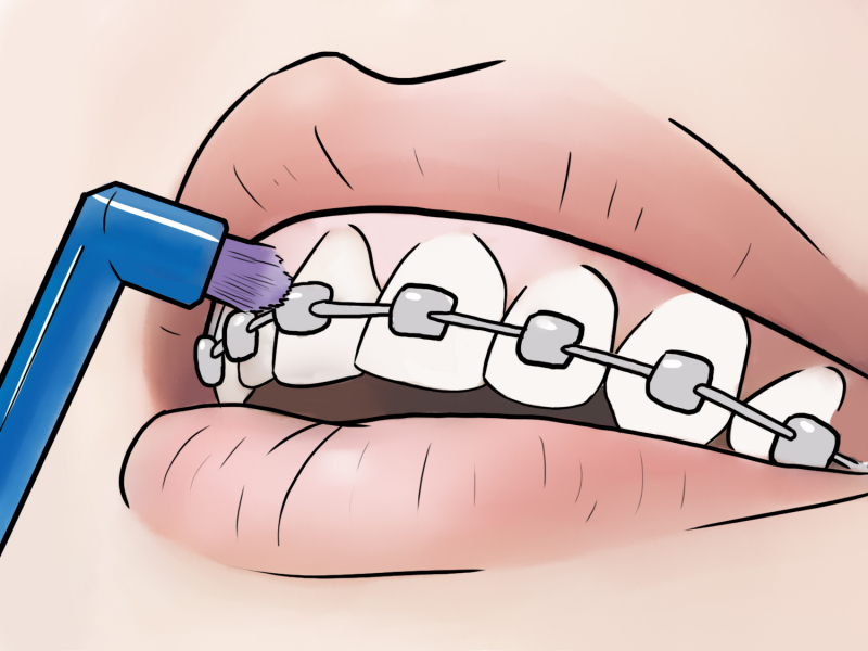 Поддержание гигиены полости рта при ношении брекетов Damon