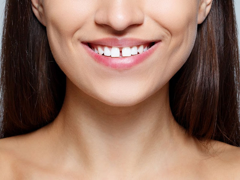 Методы лечения диастемы