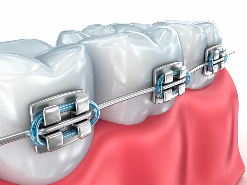 Использование брекетов Damon для исправления глубокого прикуса 
