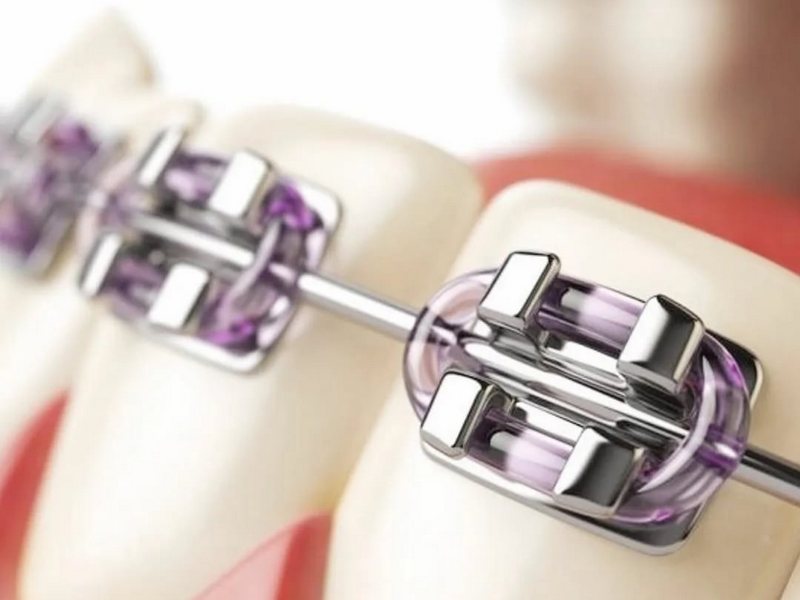 Брекеты Ormco Damon для детей. Особенности лечения детей и подростков.