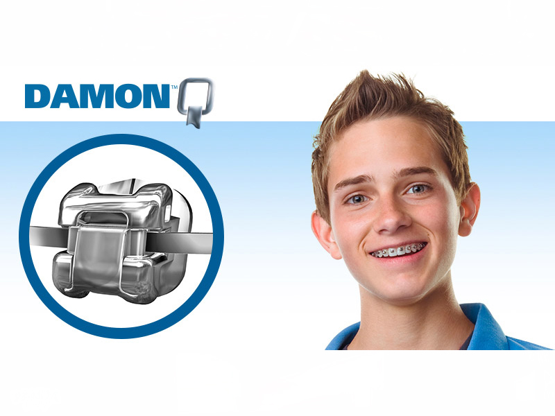 Брекеты Damon как маркетинговый инструмент: как выбрать систему, которая привлекает клиентов без дополнительных рекламных бюджетов