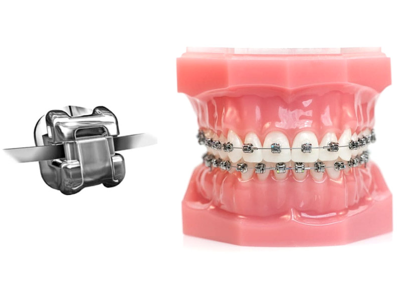 Технология Damon - индивидуальные брекет-системы, учитывающие особенности каждого пациента