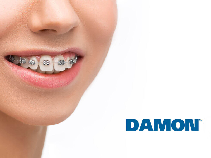 Снижение складских издержек: почему Damon требует меньше запасов, чем классические брекеты