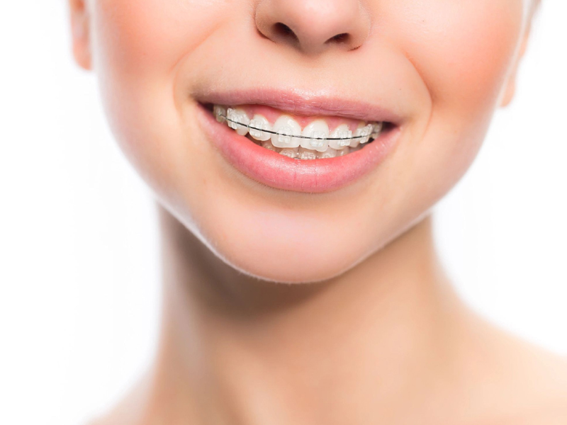 Бюджетные vs премиальные брекеты: как оптовику сформировать сбалансированный ассортимент для разных типов клиник