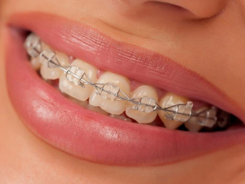 Лигатурные эстетические брекеты: почему они остаются востребованными в современной ортодонтии
