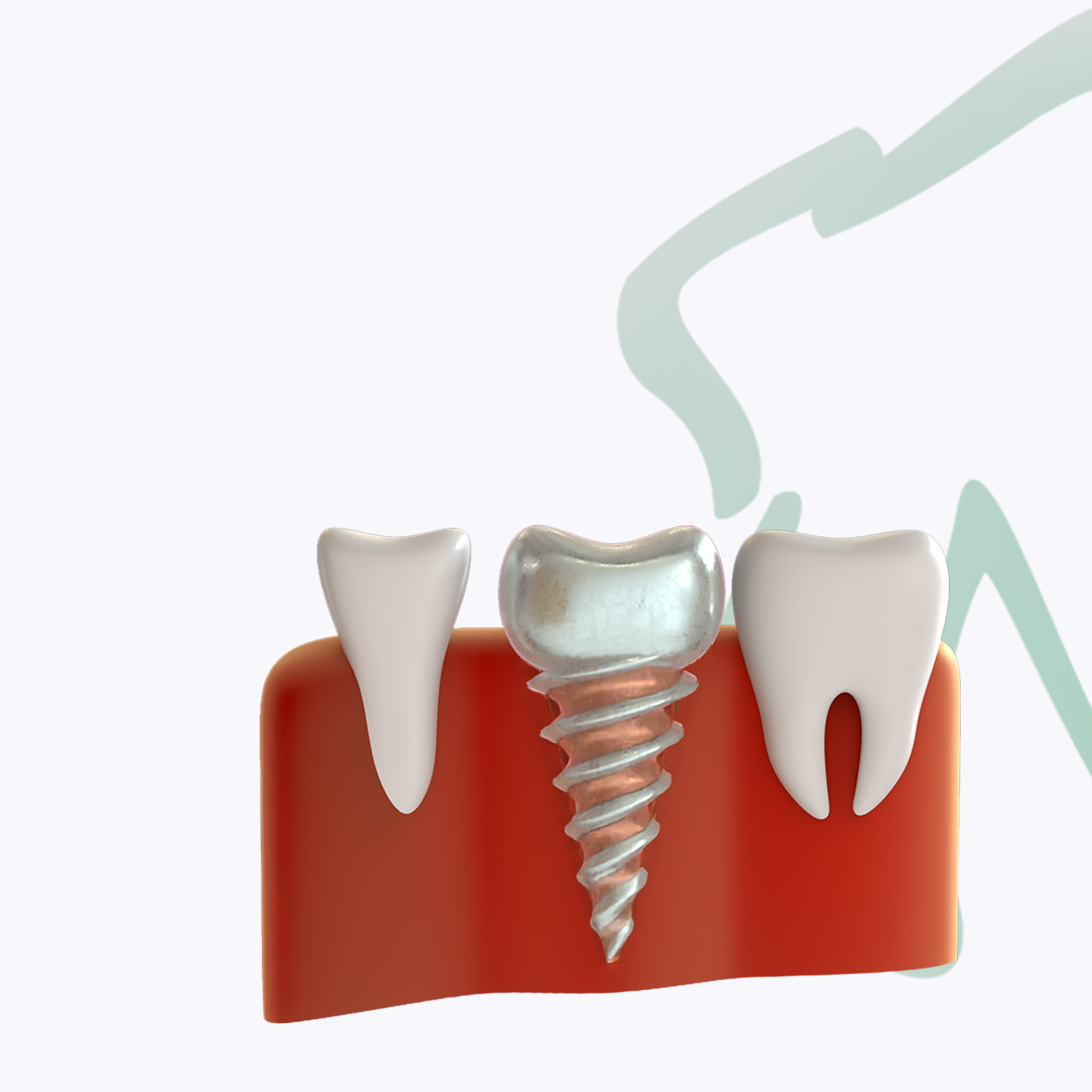 Имплантационные системы