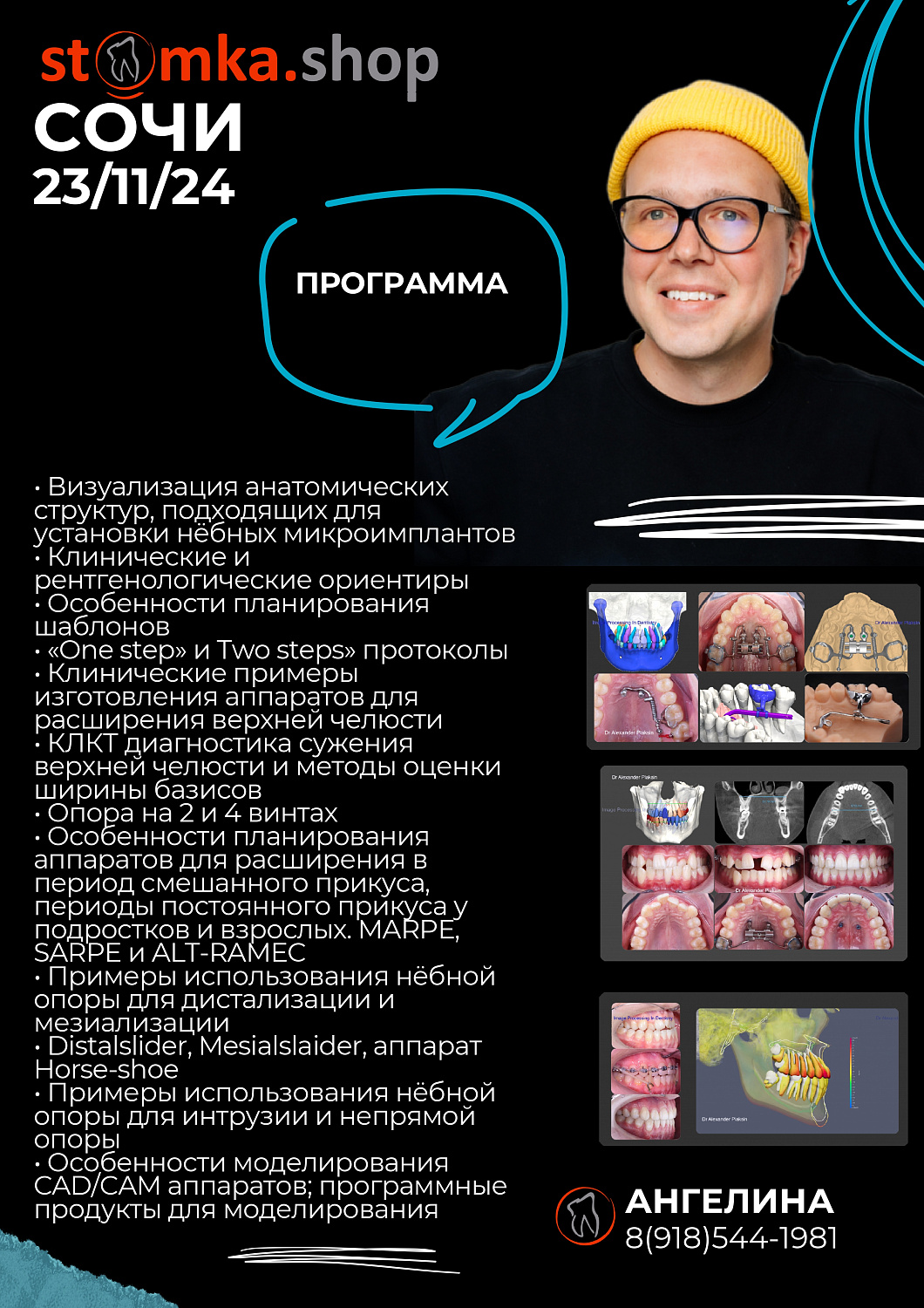 Применение небной опоры в практике врача-ортодонта.